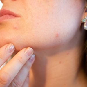 Wellhealthorganic.com : Remove Dark Spots on Face Tang – Lemon Juice
